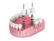 3d render of jaw with dental bridge supported by implants over white