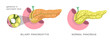 Acute pancreas inflamation caused by the obstruction of the pancreatic duct with stones. Biliary pancreatitis. Disease diagnostic procedure illustration. 