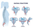 Sacral fracture with backbone skeletal trauma or injury types outline diagram. Labeled educational scheme with broken longitudinal and transverse zone vector illustration. Vertebrae accident anatomy.