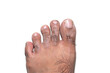 Image of a man's feet on a white background with fungal dermatitis on the toes causing peeling, scaly, itchy skin.