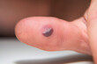 Blood blister under the thumb skin. Caucasian young man finger on white background.