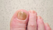 © lenblr - Toenails of woman with fungal infection. Brown bruise under nail of big toe. Senior woman touches injured toenail by index finge, top view