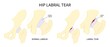 © Pepermpron - Trauma injury of hip bone Pain and range of motion groin head tear Treat joint thigh femur injury spurs socket lesion