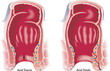 Medical illustration shows two common anal disorders, an anal fissure and an anal fistula.