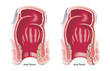 Medical illustration shows two common anal disorders, an anal fissure and an anal fistula.