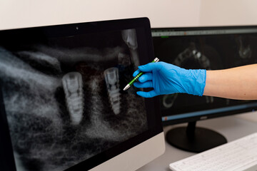 Teeth x ray professional examination. Monitor of dental healthcare.