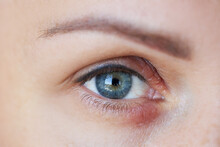 Peeling And Swelling On The Eyelid Of The Human Eye