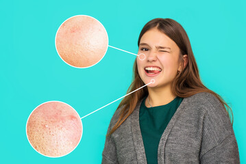 Wall Mural - Headshot Portrait of happy teenage female with smiling looking at camera on blue background. Studio. Skin disease concept