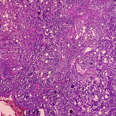 Wall Mural - Tumor from dorsal spine (biopsy): Psammomatous meningioma. Heavily calcified intracranial or spinal mass lesion, show soft tissue of spine.