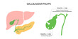 Gallbladder polyp anatomy