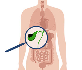 Sticker - gallbladder cancer anatomy