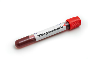 Poster - ESR Erythrocyte Sedimentation Rate Test Medical check up test tube with biological sample