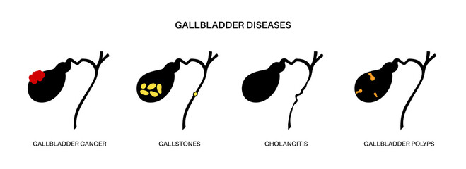 Sticker - Gallbladder diseases poster