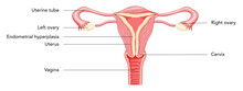 Endometrial Hyperplasia Female Reproductive System Uterus In Different Styles Diagram With Inscriptions Text Front View In A Cut. Human Anatomy Internal Organs Diseases Location Scheme Flat Style Icon