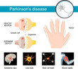 Parkinson's disease Infographic. Symptoms of a parkinsonism.