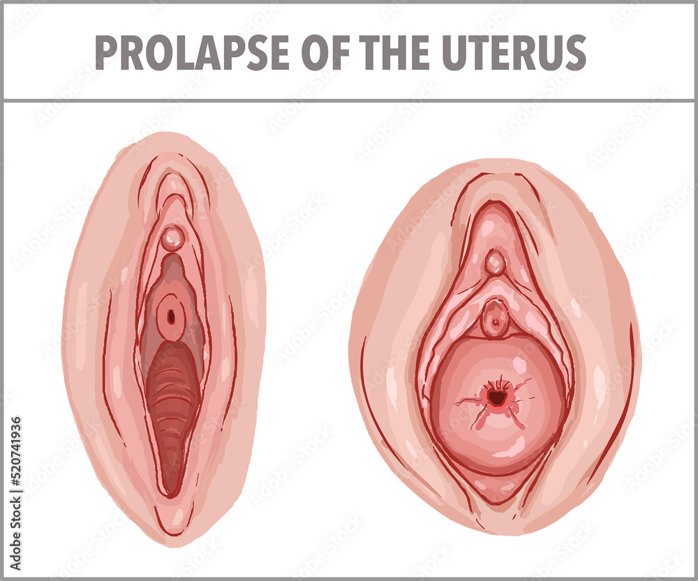 prolapse Prolapse of the uterus. gynecology vector illustration の Stock イラスト | Adobe  Stock