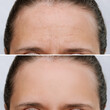 Young caucasian woman with wrinkles on the forehead before and after face lift, botox procedure isolated on a white background. Wrinkling the forehead. Anti-aging treatment. Skin care. Beauty concept