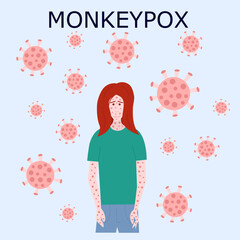 Monkey pox outbreak vector virus illustration. Monkey pox infographic on patient flat illustration