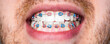 Close to the teeth braces on the white teeth of man to equalize the teeth. Dental concept