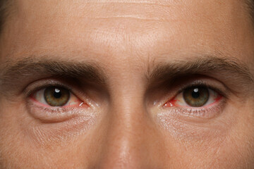 Poster - Closeup view of man with inflamed eyes