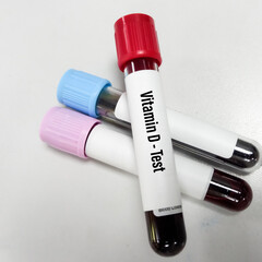 Wall Mural - Blood sample for Vitamin D test with white background. Close up. Osteoporosis.