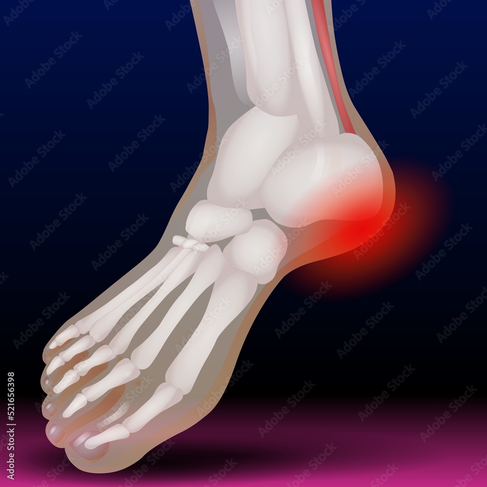 Toe Bone - Fla source file available - Fractures of the toes and ...