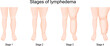 lymphedema stages.