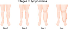 Lymphedema Stages.