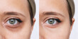 Cropped shot of young caucasian woman's face with dark circles under eyes before and after cosmetic treatment on a white bqckground. Bruises under eyes. Result of therapy, use of concealer