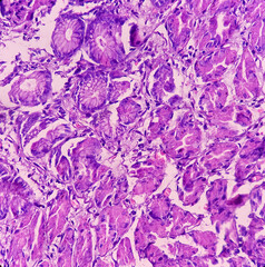 Sticker - Microscopic image of stomach body(Biopsy), Hyperplastic polyp. Show gastric mucosa, polypoid growth of dilated gastric gland and oedematous stroma.