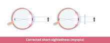 Corrected Short-sightedness (myopia). Eye Condition Where One Cannot See Objects Far Away Clearly, Corrected With Glasses Or Contact Lenses.