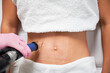 Close up of woman's abdomen exposed to laser polishing. Visible traces in form of white dots immediately after procedure. CO2 laser is effective method of treating scars and postpartum stretch marks.