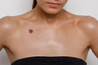 acne close-up on the female breast, problematic teenage skin