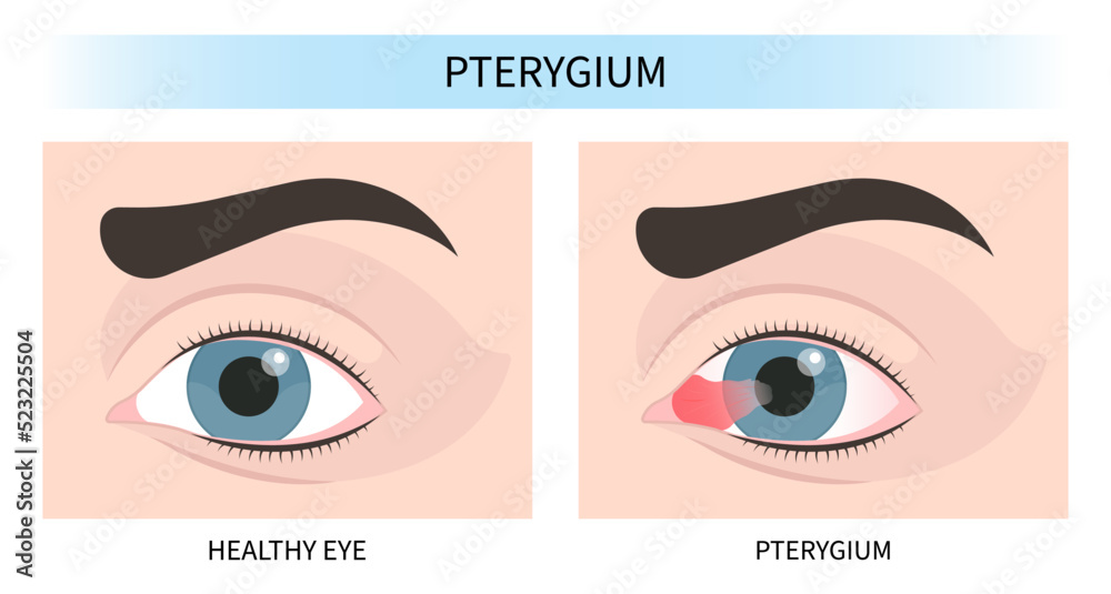 itchy and dry eye pink red surfer's blurry ulcer bacteria lens vision ...