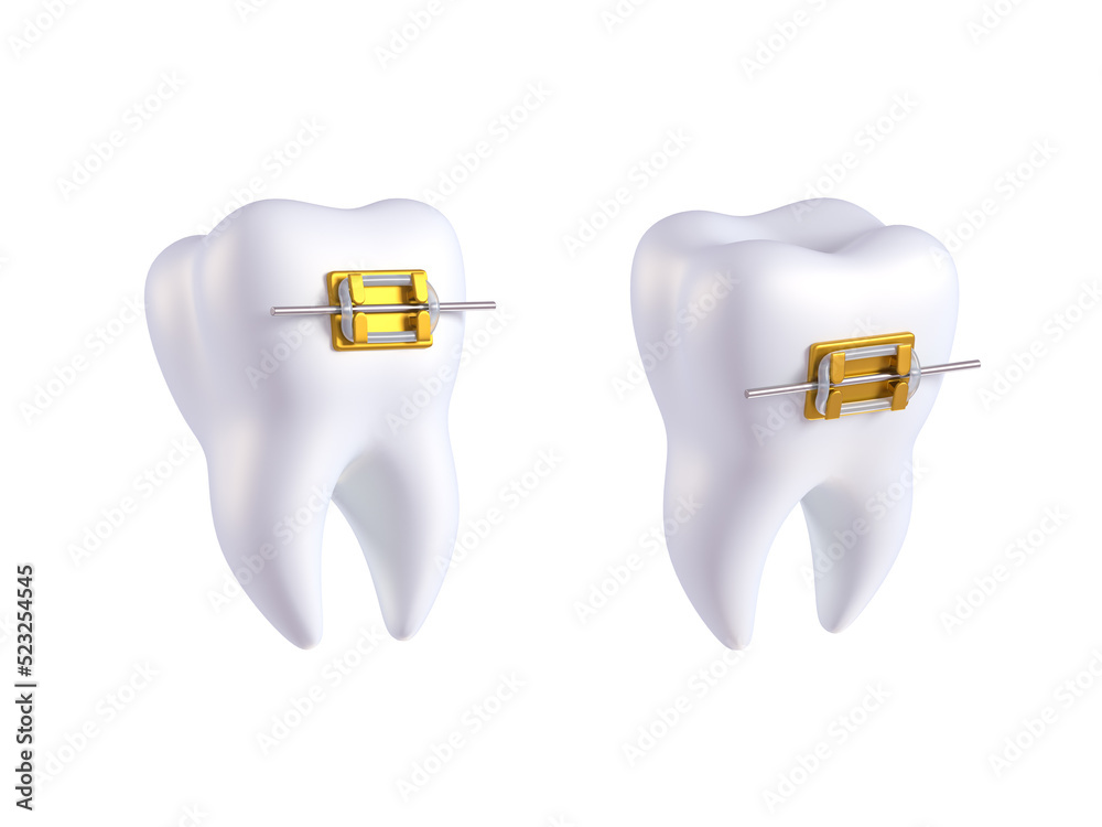 Teeth with or without golden braces. Arch braces without teeth ...