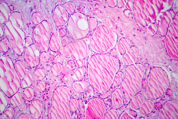 Wall Mural - Fibrous thyroiditis, light micrograph