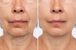 Leinwandbild Motiv Lower part of face and neck of an elderly woman with signs of skin aging before after facelift, plastic surgery. Age-related changes, flabby sagging skin, wrinkles, creases, puffiness. Rejuvenation