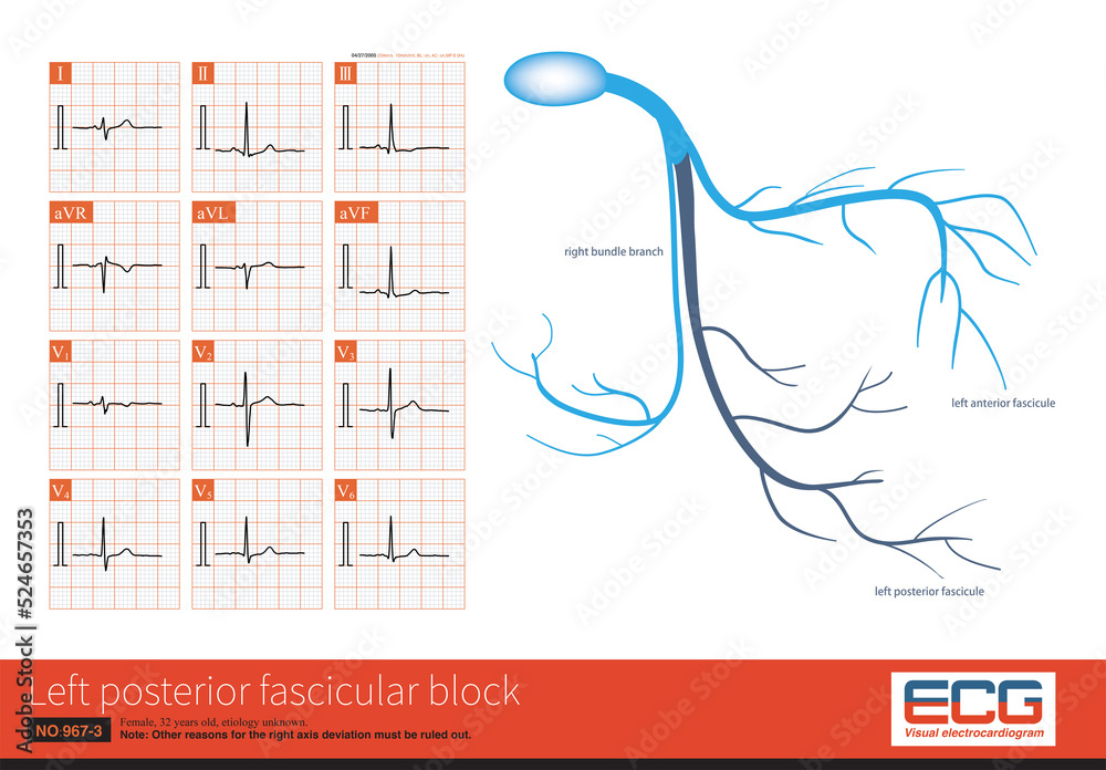 Illustration Stock During left posterior fascicular block, the ECG ...