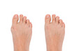 Hallux valgus deformity of the big toe caused by wearing uncomfortable shoes. A woman's  foot before and after treatment  isolated on a white background. Orthodontics 