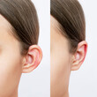 Cropped shot of young woman's head with ears before and after otoplasty on a white background. Result of cosmetic plastic surgery of correction auricles and getting rid of lop - eared