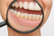 Young woman's teeth with tartar enlarged in a magnifying glass isolated on a white background. The girl showing yellow plaque on the basis of teeth. Oral hygiene, dental health. Macro shot