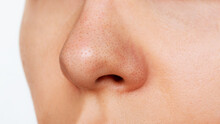 Close-up Of A Woman's Nose With Blackheads Isolated On A White Background. Acne Problem, Comedones. Enlarged Pores On The Face. Cosmetology Dermatology Concept. Black Dots On The Female Nose