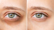 © Марина Демешко - Cropped shot of young caucasian woman's face with dark circles under eyes before and after cosmetic treatment on a white bqckground. Bruises under eyes. Result of using concealer