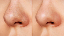 Close-up Of Woman's Nose With Blackheads Before And After Peeling And Cleansing The Face. Acne Problem, Comedones. Getting Rid Of Black Dots. Cosmetology Dermatology Concept