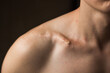Close-up of man's collarbone injury. Black background. Injured athlete after successful fractured clavicle bone surgery.