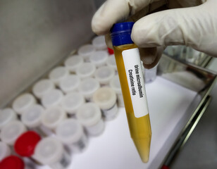 Sticker - Urine Sample for Urine ACR or microalbumin creatinine Ratio test to diagnosis Chronic kidney disease (CKD).