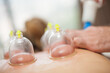 Glass vacuum cupping therapy on a woman's back, acupuncture treatment. Ventosa traditional massage. Alternative Medicine. Medical health care