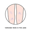 Varicose veins in the legs. Varicose spider veins anatomy. Swelling and pain in human legs. Vascular disease diagnostic and treatment. Abnormal blood pressure, weak vein and valves. vector