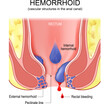 piles. hemorrhoids. Cross section of the rectum and anal canal