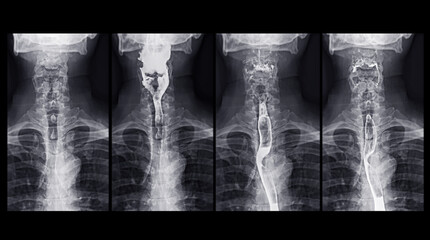 Barium Swallow study test diagnose Barrett's GI tract exam GERD ulcers series difficulty pharynx procedure UGI throat bowel therapy by fluoroscopy devices.